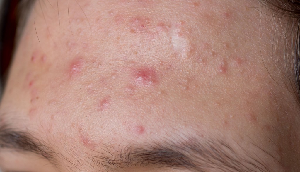 A acne geralmente “ataca” as regiões mais oleosas do rosto, assim como a testa. Para combatê-la, use sempre produtos específicos preferencialmente prescritos pelo dermatologista / GB Imagem