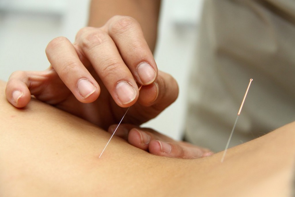 Tratamento através da acupuntura