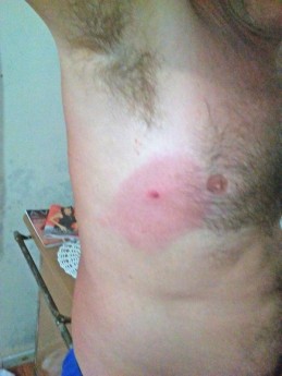 Morador da Restinga acredita que foi picado por um, embora no PA a informação de que não se trata de picada de escorpião