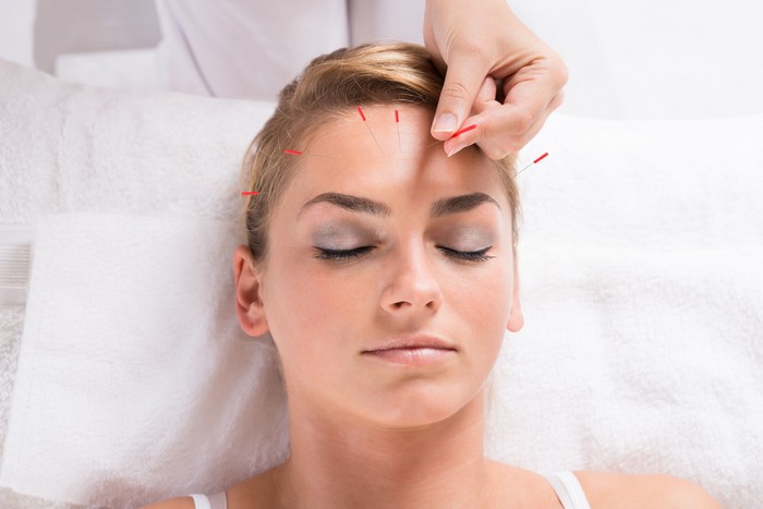A acupuntura pode tratar acne, rugas faciais, flacidez, a tonificação dos músculos, assim como tonificação da pele para estimular os fibroblastos a produzirem colágeno e a elastina / GB Imagem